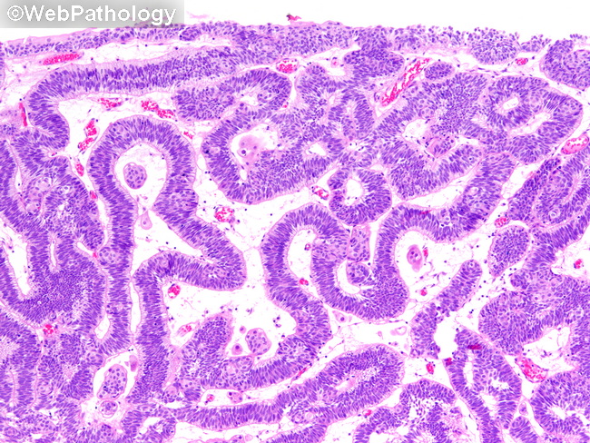 UrinaryBladder_InvertedPapilloma26.jpg