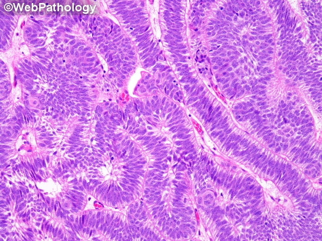 UrinaryBladder_InvertedPapilloma28.jpg