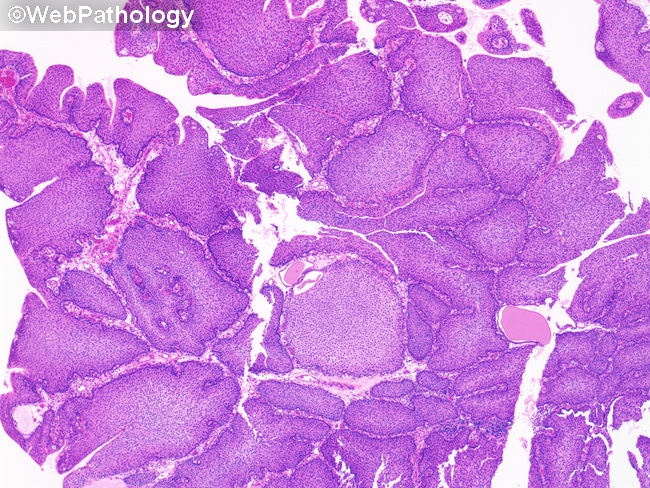 UrinaryBladder_InvertedPapilloma30_SquamousMetaplasia.jpg