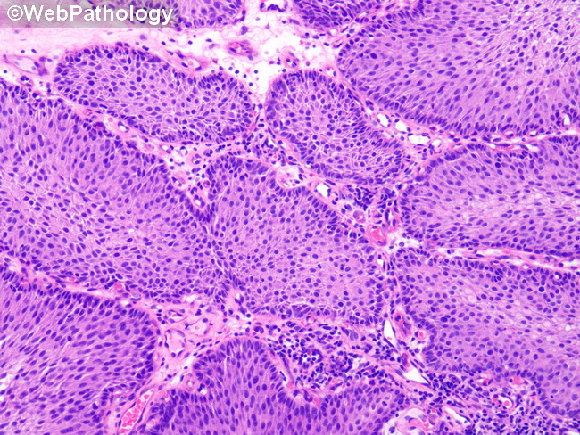 UrinaryBladder_InvertedPapilloma32_SquamousMetaplasia.jpg