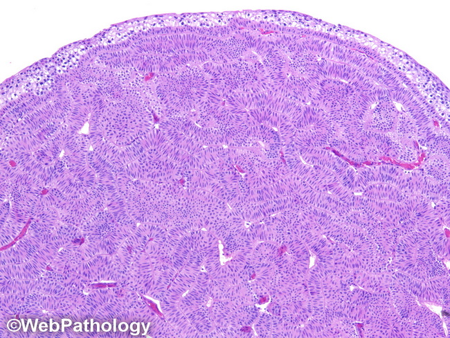 UrinaryBladder_InvertedPapilloma35_resized.jpg