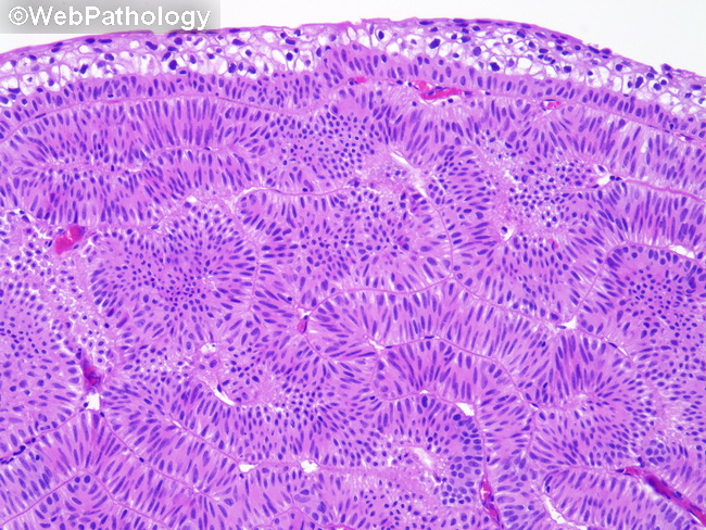 UrinaryBladder_InvertedPapilloma36.jpg