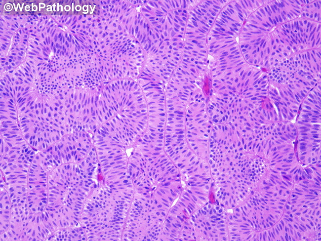 UrinaryBladder_InvertedPapilloma37.jpg