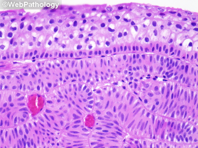 UrinaryBladder_InvertedPapilloma38.jpg