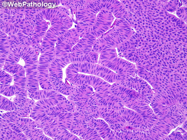 UrinaryBladder_InvertedPapilloma40.jpg