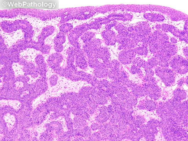 UrinaryBladder_InvertedPapilloma41.jpg