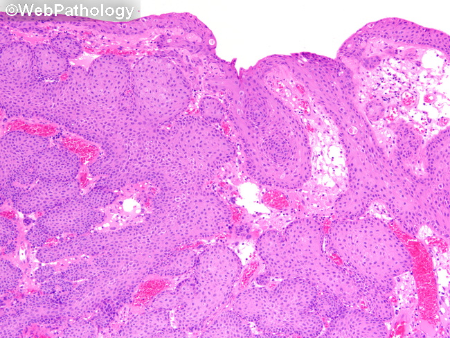 UrinaryBladder_InvertedPapilloma42.jpg