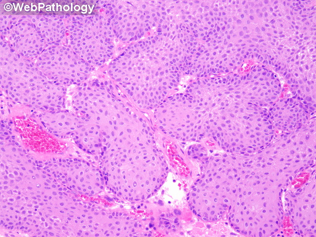 UrinaryBladder_InvertedPapilloma43.jpg