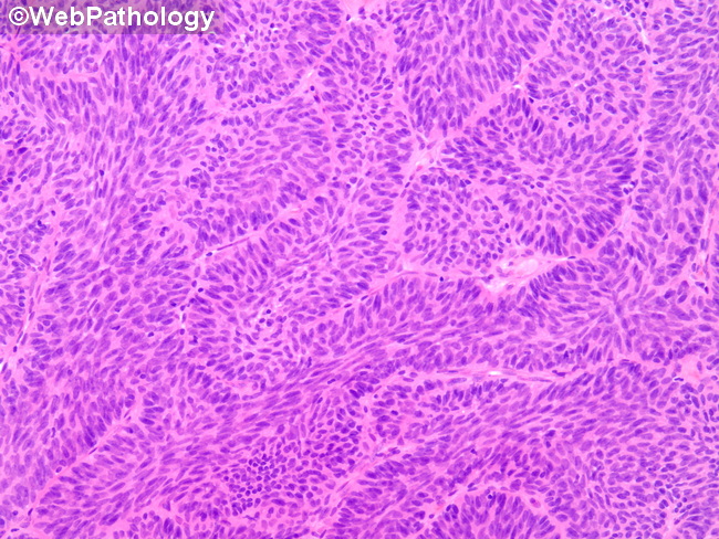 UrinaryBladder_InvertedPapilloma44.jpg