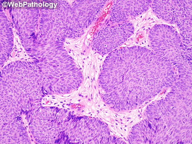 UrinaryBladder_InvertedPapilloma54.jpg