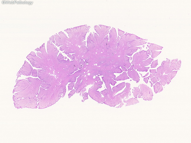 fibroepithelial polyp histology