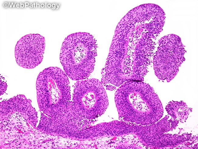 UrinaryBladder_UrothelialCarcinoma_PUNLMP1A.jpg