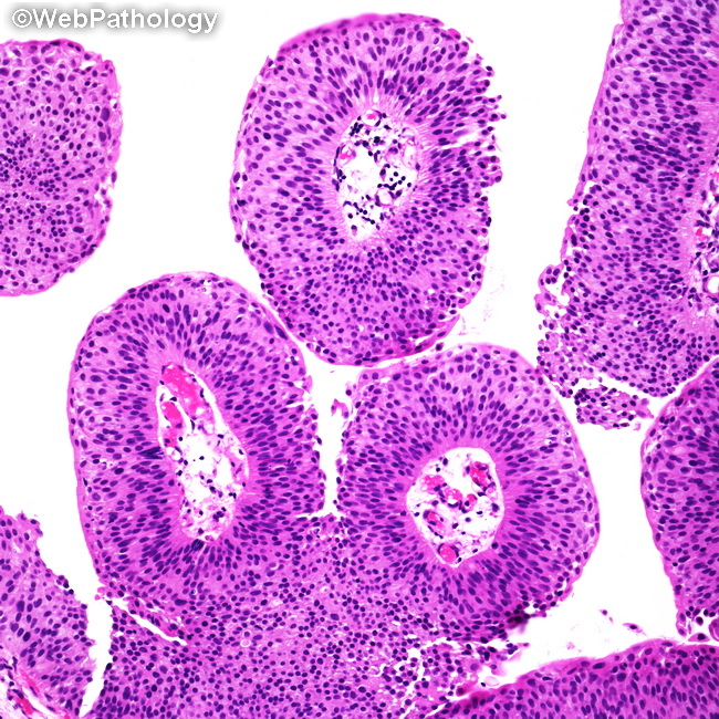 UrinaryBladder_UrothelialCarcinoma_PUNLMP2A.jpg