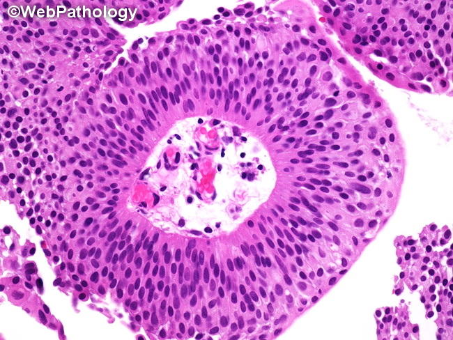 UrinaryBladder_UrothelialCarcinoma_PUNLMP3A.jpg