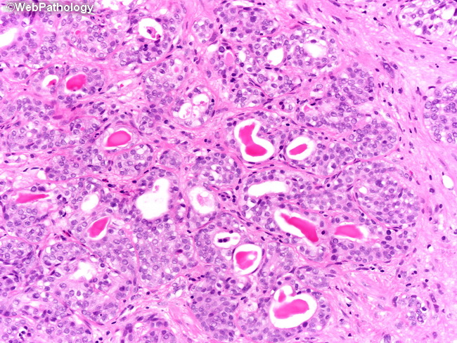 Pediatric Head And Neck Squamous Cell Carcinoma