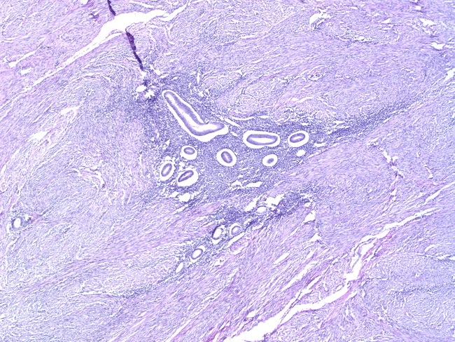 Uterus_Adenomyosis2.jpg