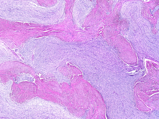 Uterus_EndometrialStromalSarcoma_VascularInvasion3.jpg