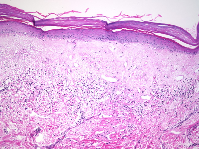 lichen planus histology