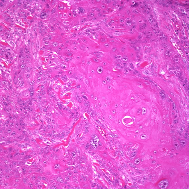 vulvar squamous cell carcinoma